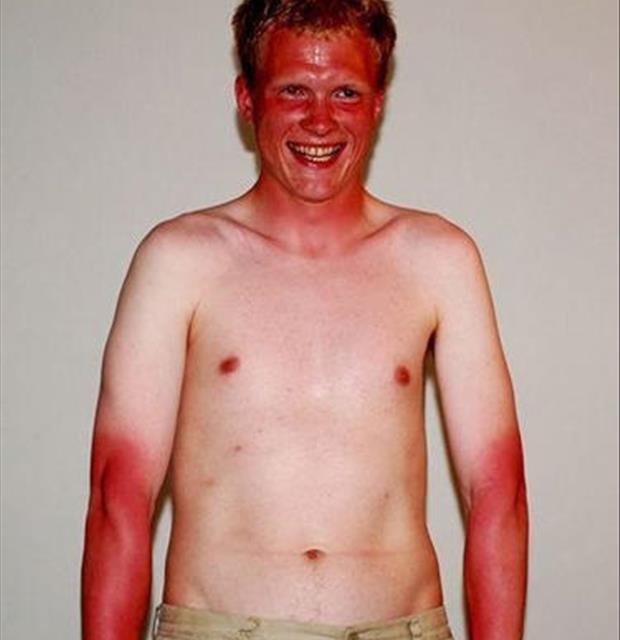 Les pires coups de soleil! Ouch!!!