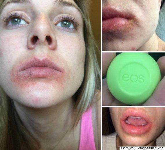 Le baume à lèvres EOS causerait des blessures